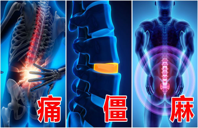 腰椎間盤突出最好的治療方法 腰椎間盤突出最好的治療方法