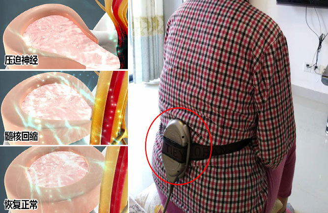 腰間盤突出什么癥狀